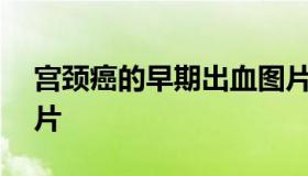 宫颈癌的早期出血图片 女性hpv感染早期图片
